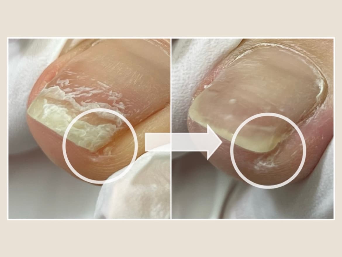 Ingrown toenail correction professional treatment